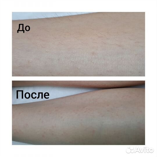 Электроэпиляция
