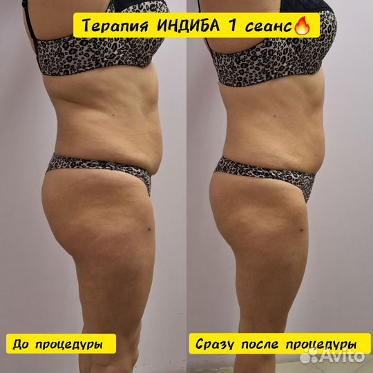 LPG массаж/вибро/вакуум/индиба