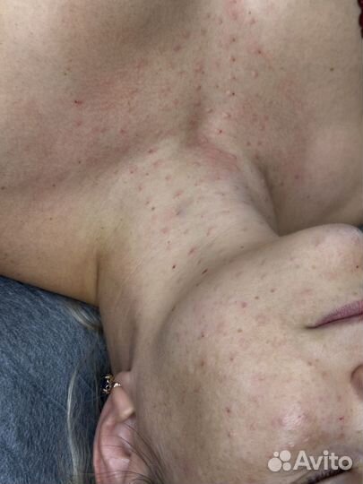 Плазмолифтинг