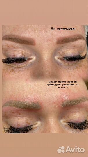 Лазерное удаление татуажа и тату