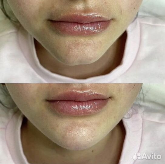 Контурная пластика лица