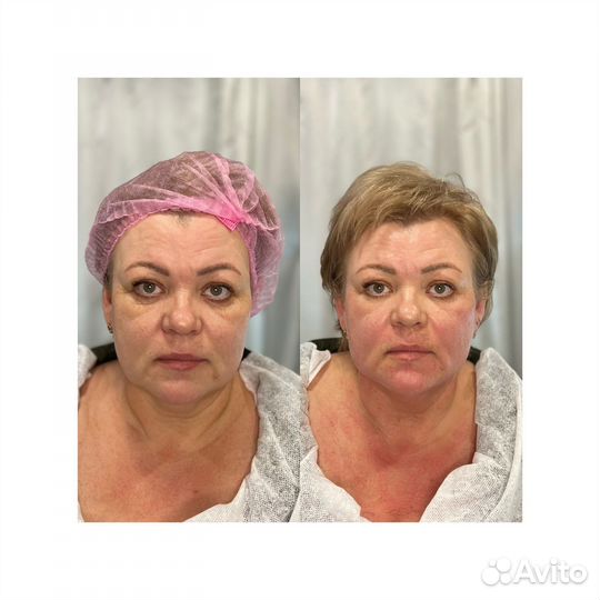 Игольчатый РФ лифтинг