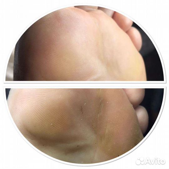 Педикюр аппаратно-препаратный