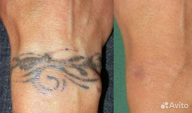 Лазерное удаление тату и татуажа
