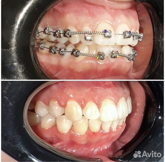 Брекеты