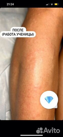 Обучение электроэпиляции