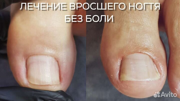 Педикюр подолог