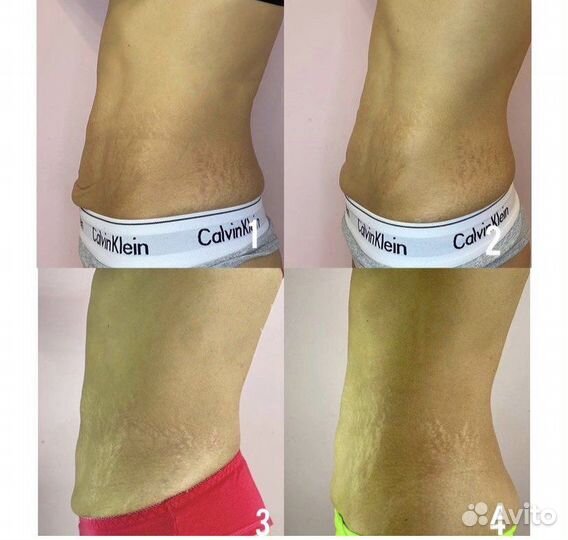 Подтяжка животика, смас лифтинг