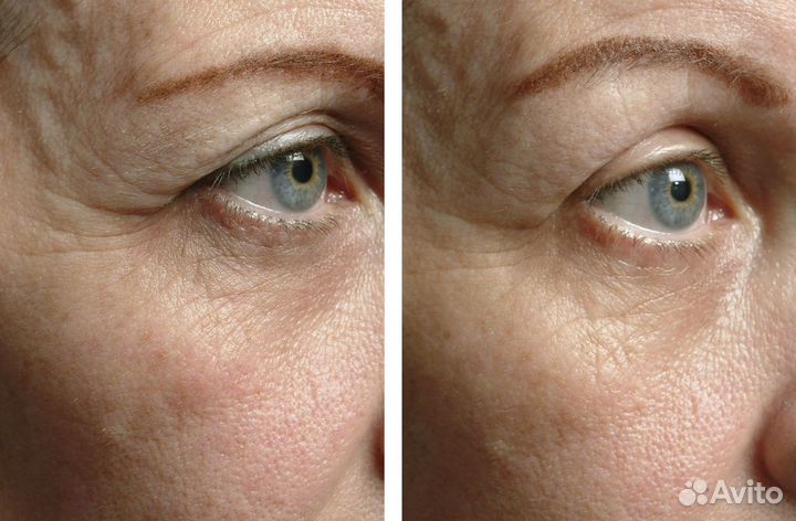 Модели на Rf-лифтинг Век (бесплатно)