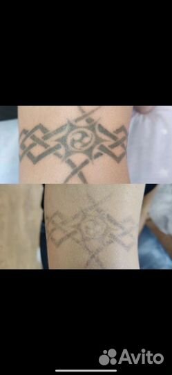 Удаление тату и татуажа лазером