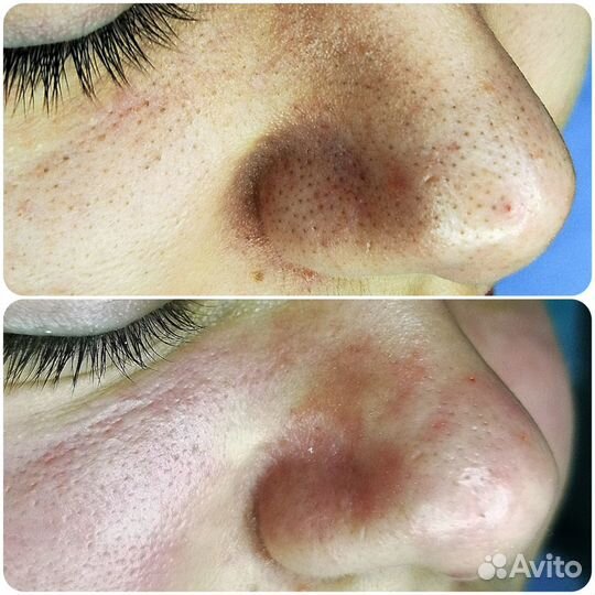 Карбокситерапия