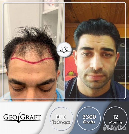 Пересадка волос