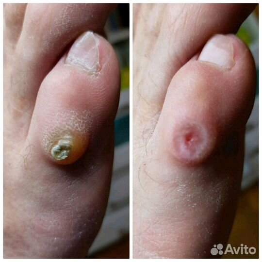 Вросший ноготь, трещены, мозоли, бородавки