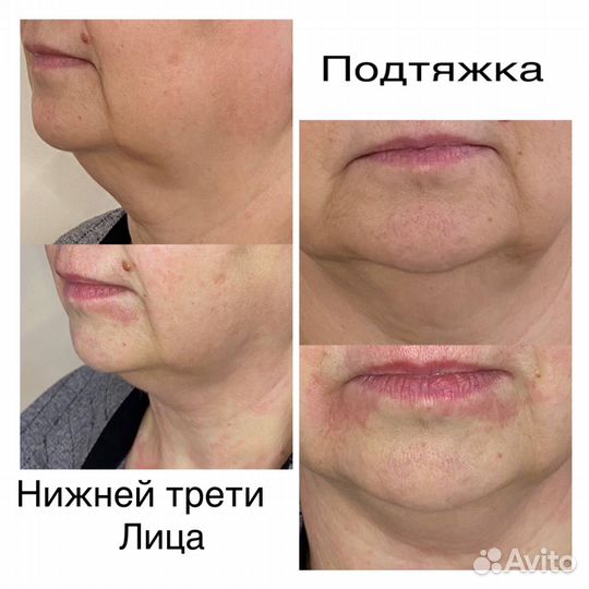 Безоперационная блефаропластика