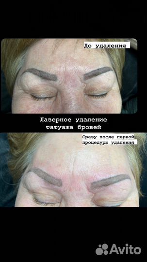 Лазерное удаление татуажа и тату