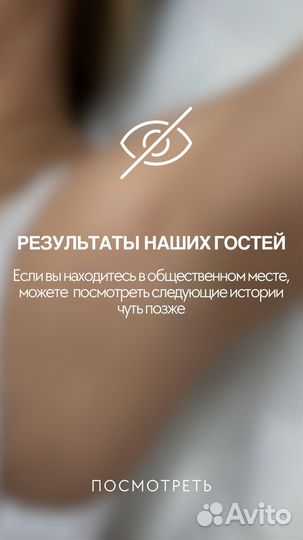 Лазерная эпиляция