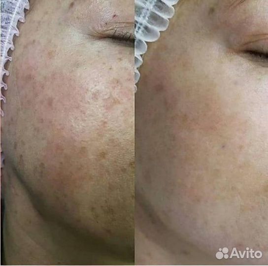 Шугаринг депиляция