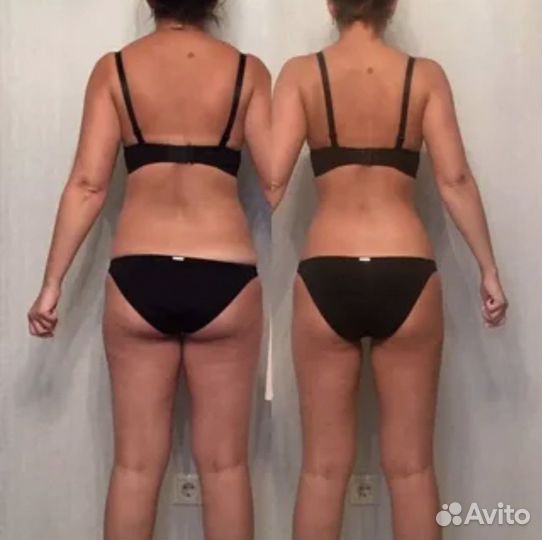 Прессотерапия