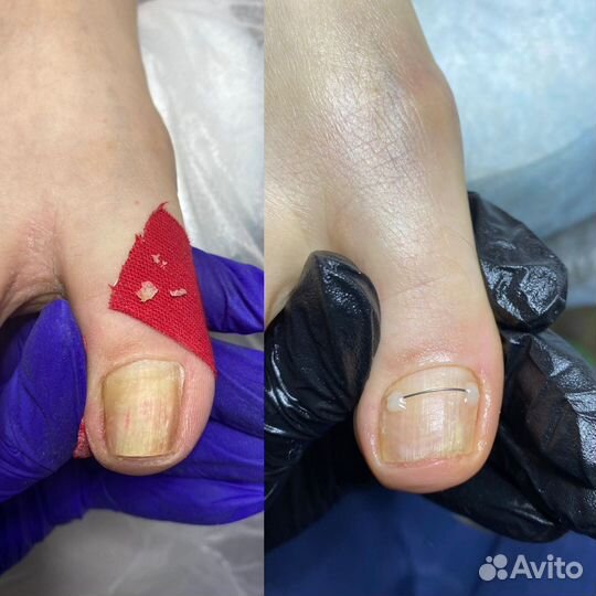 Подолог. Вросший ноготь. Титановая нить