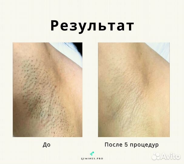 Аппарат для эпиляции Люминес’ Макс’Ван 1200W