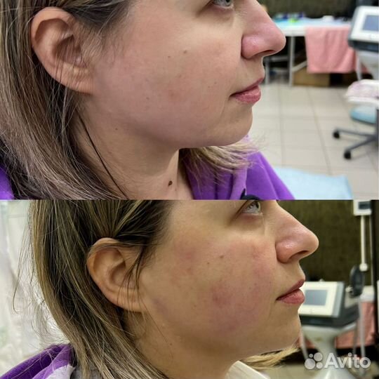 Смас-лифтинг Ультраформер (Ultraformer)