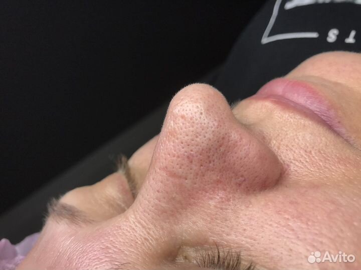 Лечение угревой сыпи