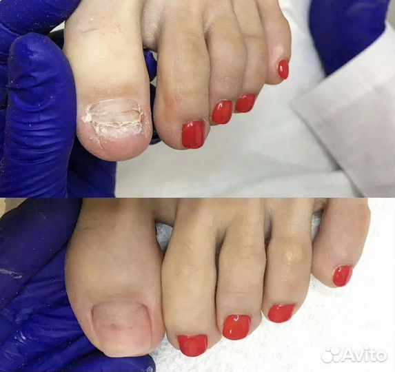 Лечебный педикюр Подолог