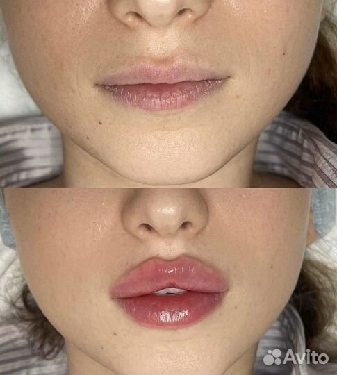 Увеличение губ