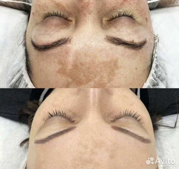 Удаление пигментных пятен