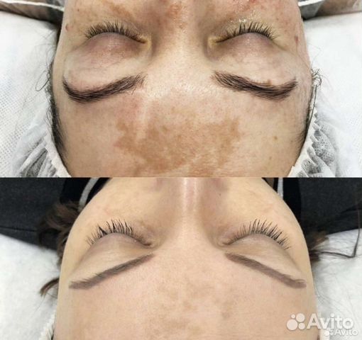 Удаление пигментных пятен