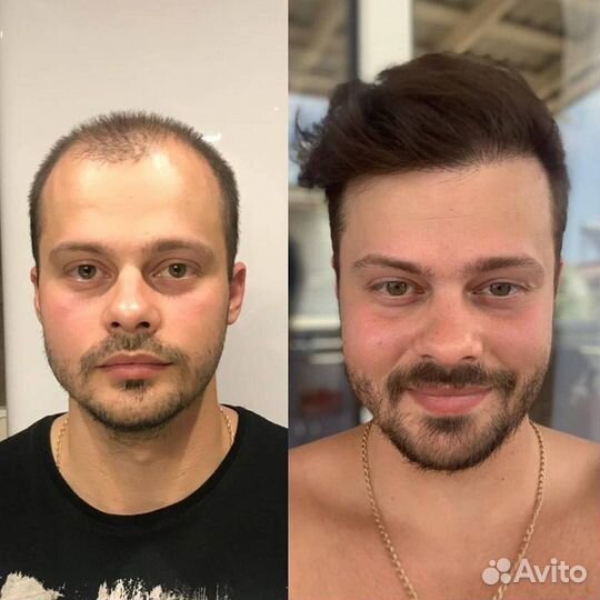 Пересадка волос за 1 день