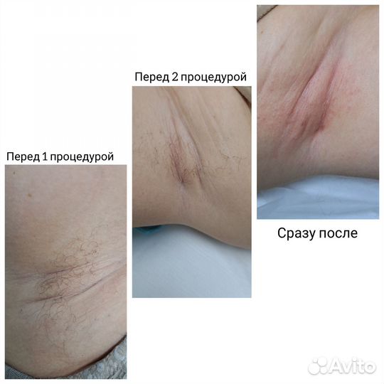 Электроэпиляция