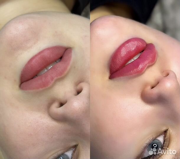 Контурная пластика губ