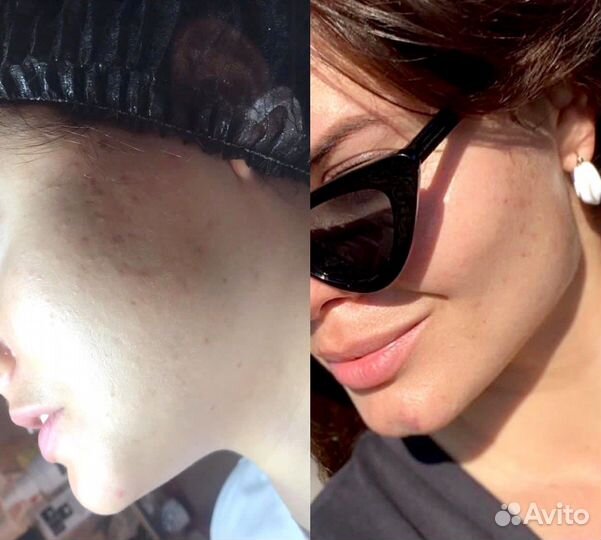 Лицо под ключ, Фулл Фейс, Овал Джоли