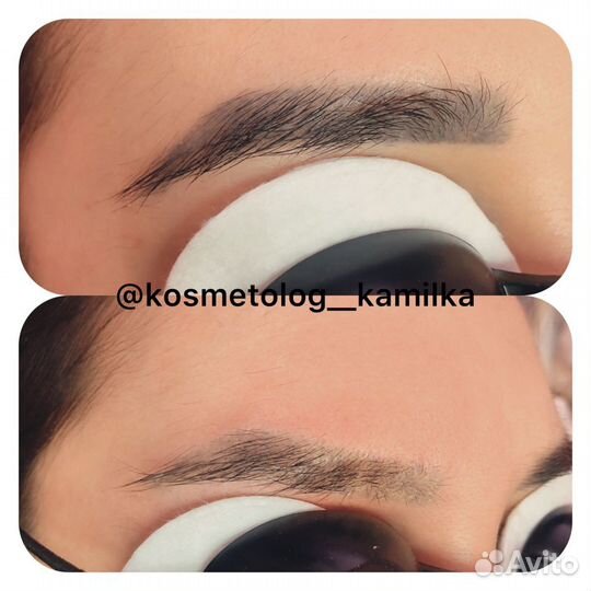 Лазерная эпиляция: бакенбарды