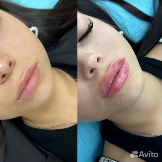 Увеличение губ