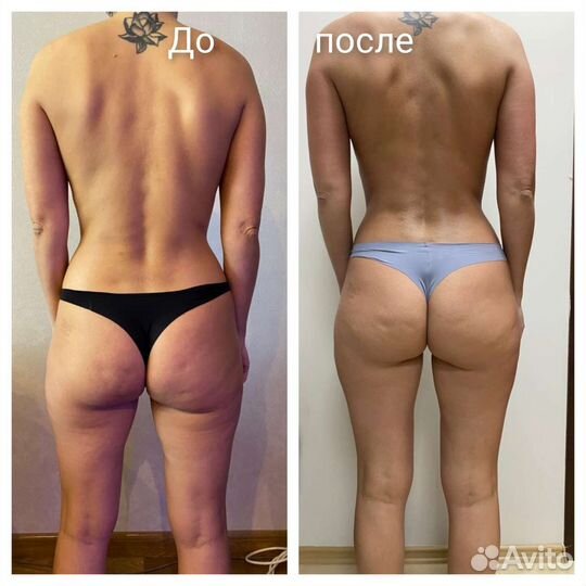 Lpg массаж/Аппаратная методика