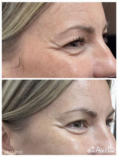 Смас-лифтинг