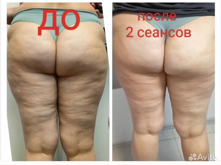 Похудеть за 2 сеанса Индиба частота 448кГц