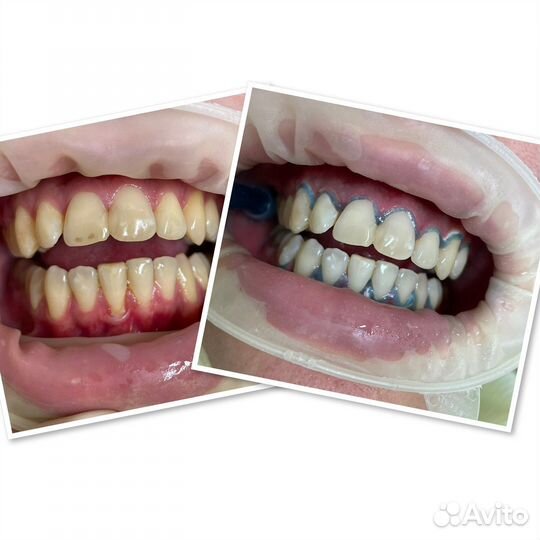 Здоровые,белоснежные зубы