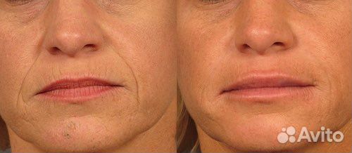 Носогубные складки