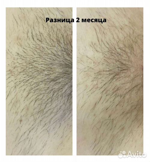 Электроэпиляция