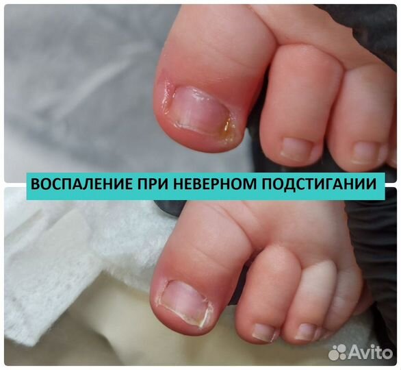 Медицинский педикюр. подолог