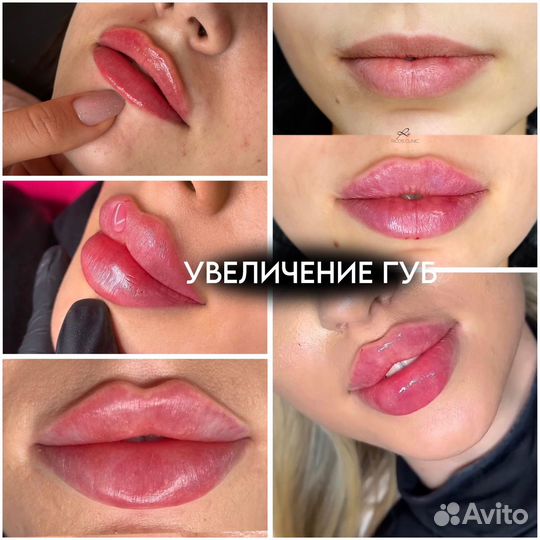 Увеличение губ, углы джоли, full face, модели