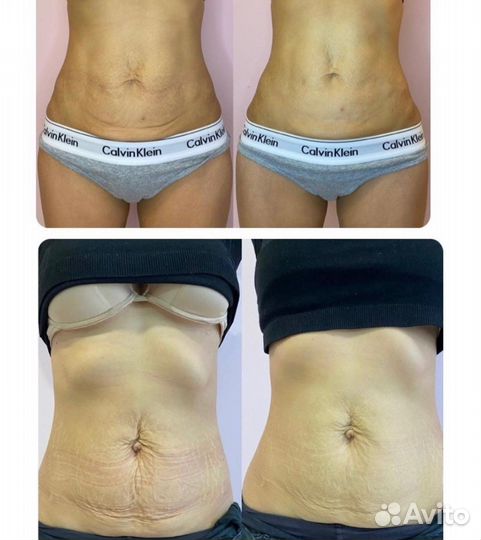 Подтяжка животика, смас лифтинг