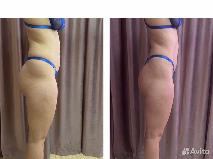 Аппаратное похудение, Массаж 