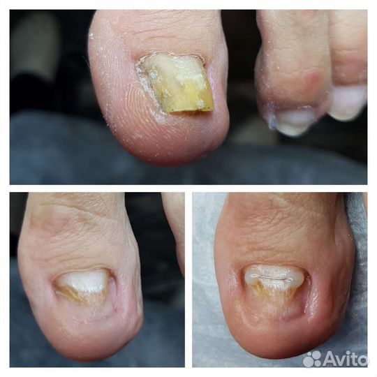 Подолог, педикюр, вросший ноготь, титановая нить