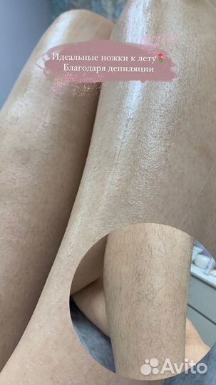 Шугаринг женский депиляция