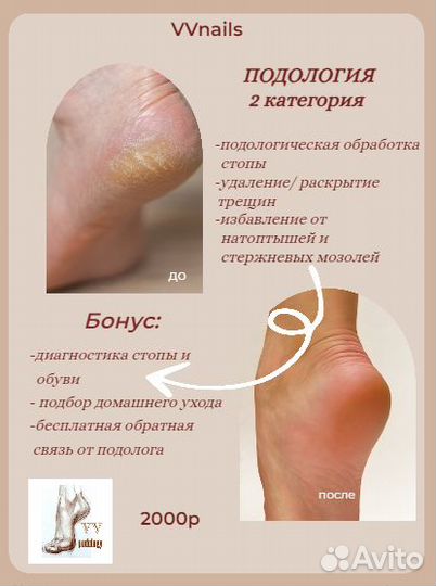 Лечебный педикюр подолог