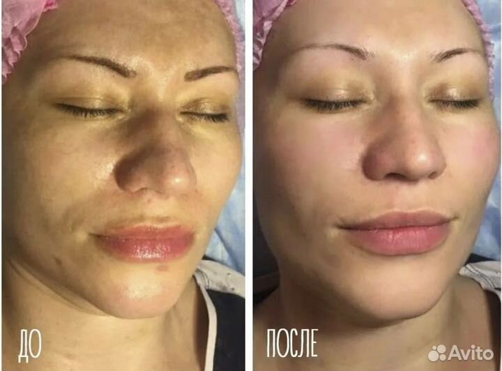 Карбоновый пилинг аппарат